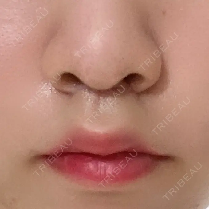 人中短縮 新宿ラクル美容外科クリニック 新宿院 DAY 21 メイン用