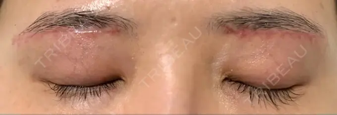 上まぶたの脂肪取り / 眉下切開 城本クリニック 福岡院 DAY 29 メイン用