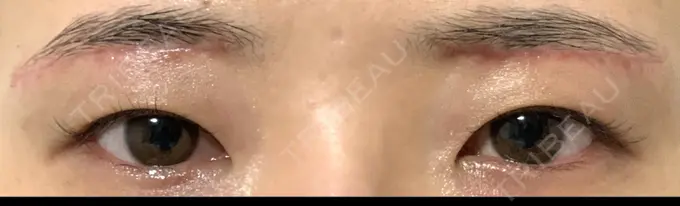 上まぶたの脂肪取り / 眉下切開 城本クリニック 福岡院 DAY 29 メイン用