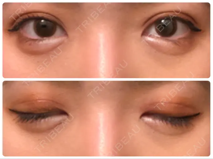 眼瞼下垂（切開） Taide Suenaga Clinic（タイデスエナガクリニック） DAY 80 メイン用