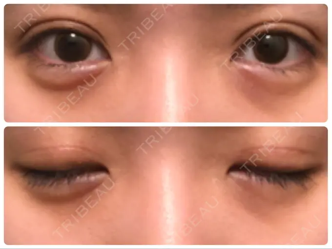 眼瞼下垂（切開） Taide Suenaga Clinic（タイデスエナガクリニック） DAY 80 メイン用