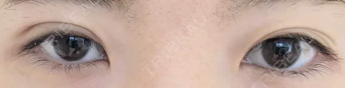 二重埋没 青山セレスクリニック 青山院 DAY 5 メイン用