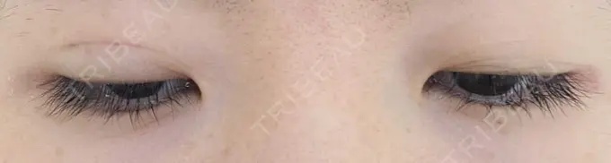 二重埋没 青山セレスクリニック 青山院 DAY 5 メイン用