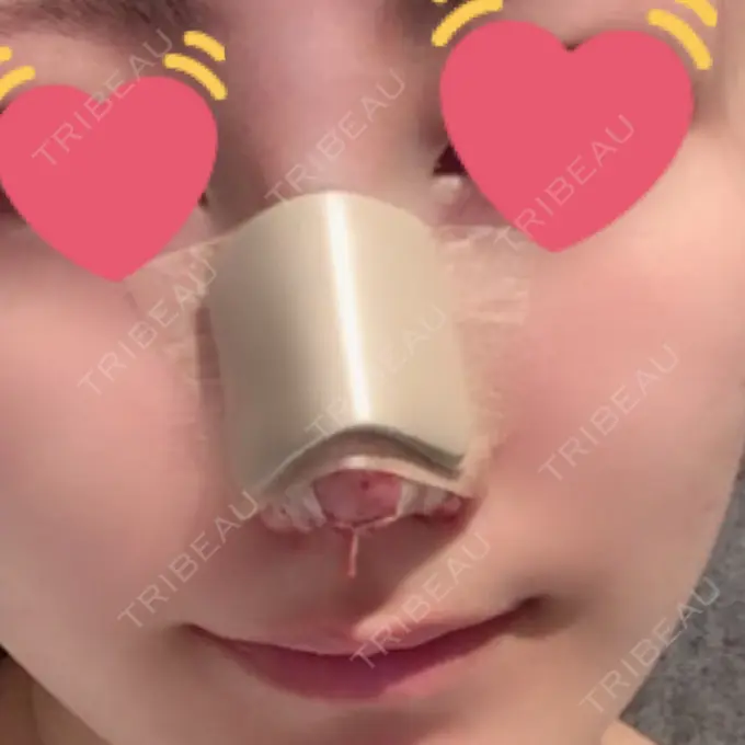 鼻尖形成（切開） / 鼻中隔延長（切開） / 眉間プロテーゼ 湘南美容クリニック 名古屋栄院 DAY 0 メイン用