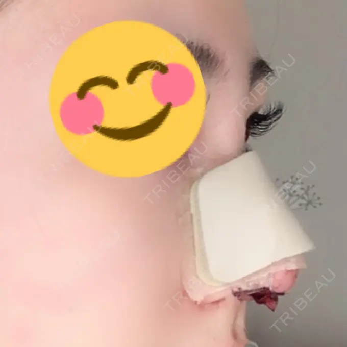 鼻尖形成（切開） / 鼻中隔延長（切開） / 眉間プロテーゼ 湘南美容クリニック 名古屋栄院 DAY 1 メイン用