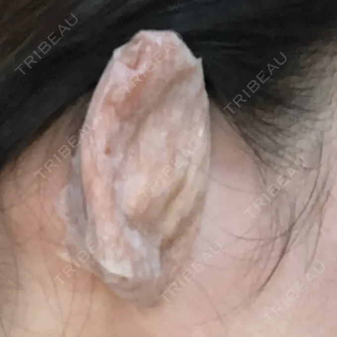 鼻尖形成（切開） / 鼻中隔延長（切開） / 眉間プロテーゼ 湘南美容クリニック 名古屋栄院 DAY 1 メイン用