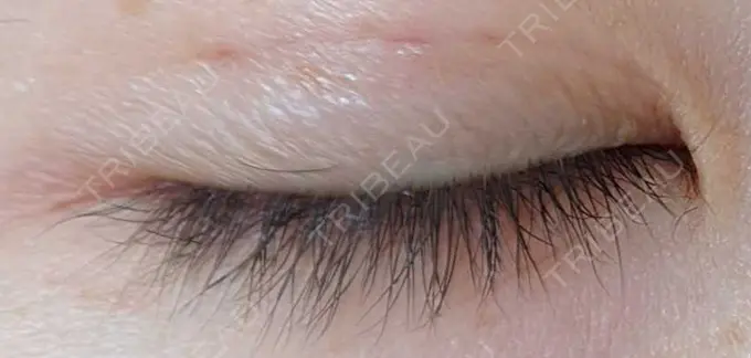 二重埋没 青山セレスクリニック 青山院 DAY 5 メイン用