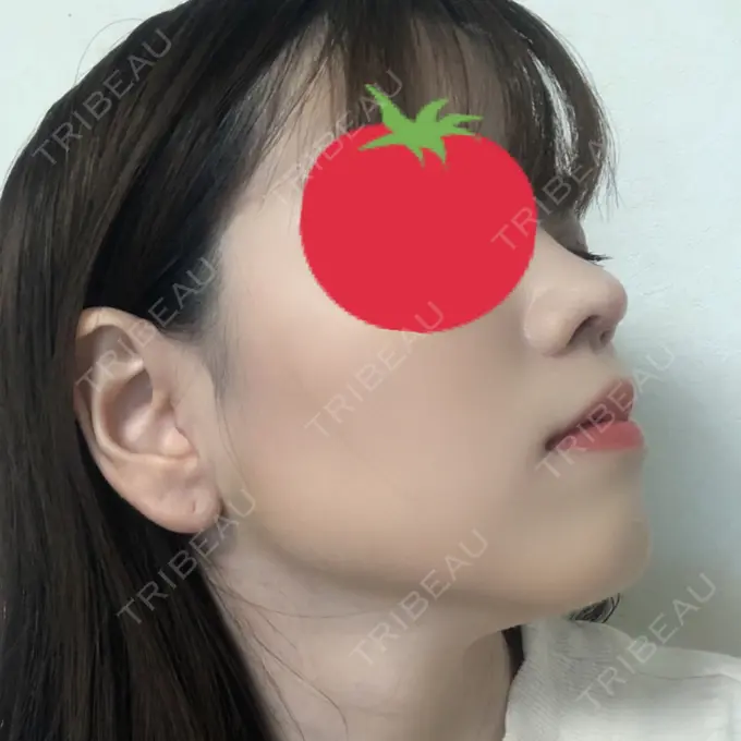 鼻尖形成（切開） みずほクリニック DAY 13 メイン用