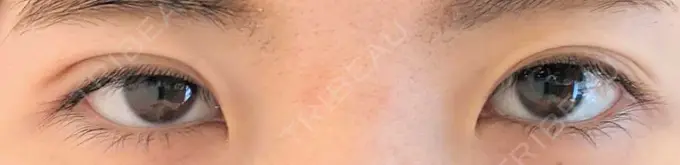 二重埋没 青山セレスクリニック 青山院 DAY 6 メイン用