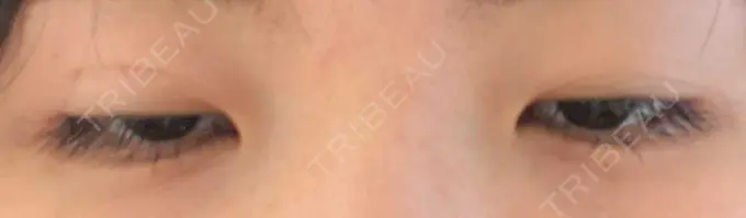 二重埋没 青山セレスクリニック 青山院 DAY 6 メイン用