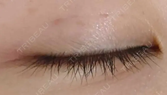 二重埋没 青山セレスクリニック 青山院 DAY 6 メイン用