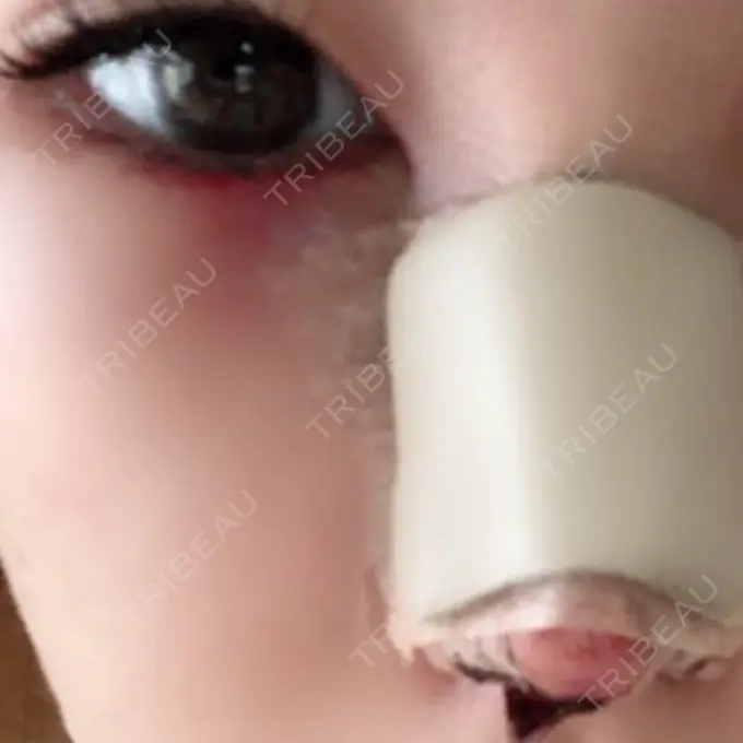 鼻尖形成（切開） / 鼻中隔延長（切開） / 眉間プロテーゼ 湘南美容クリニック 名古屋栄院 DAY 2 メイン用