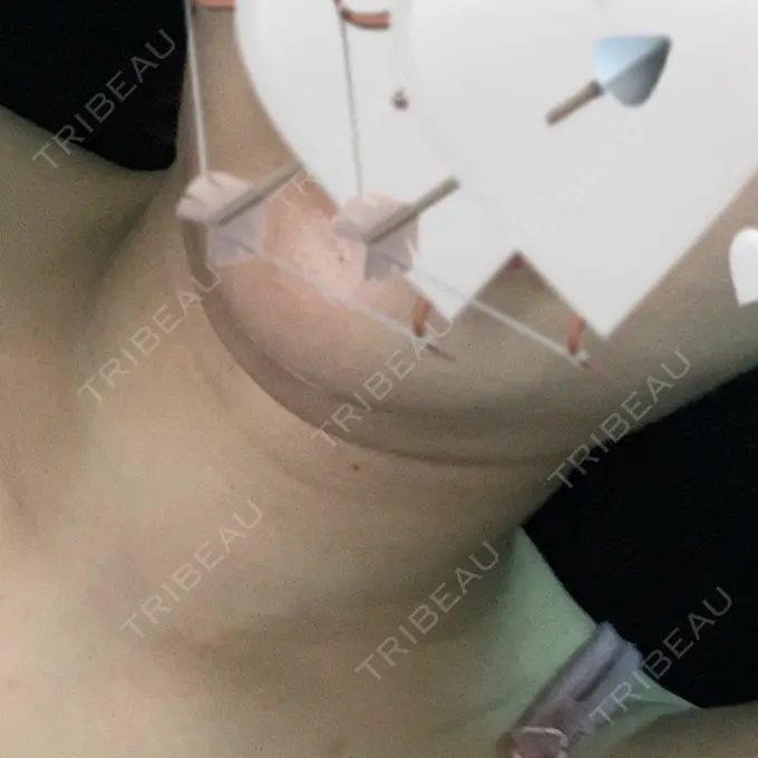 脂肪吸引（顔） ガーデンクリニック 名古屋院 DAY 27 メイン用