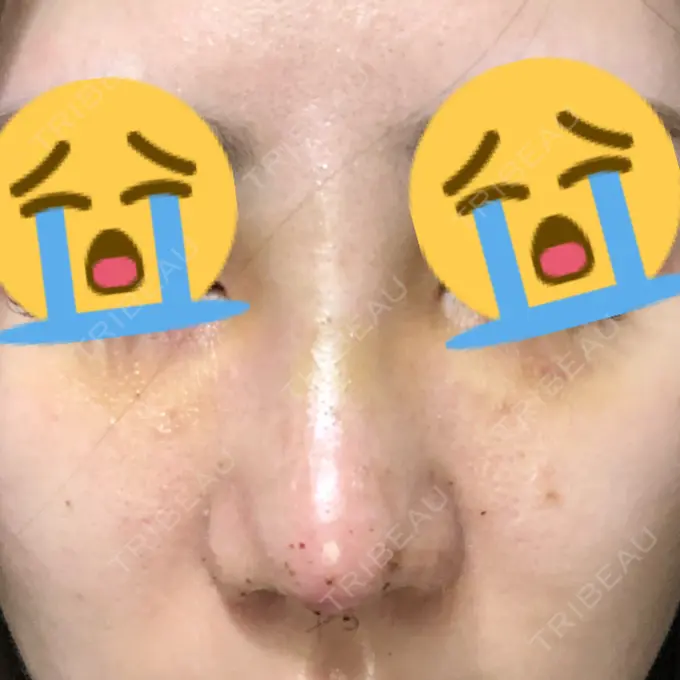 鼻尖形成（切開） / 鼻中隔延長（切開） / 眉間プロテーゼ 湘南美容クリニック 名古屋栄院 AFTER メイン用