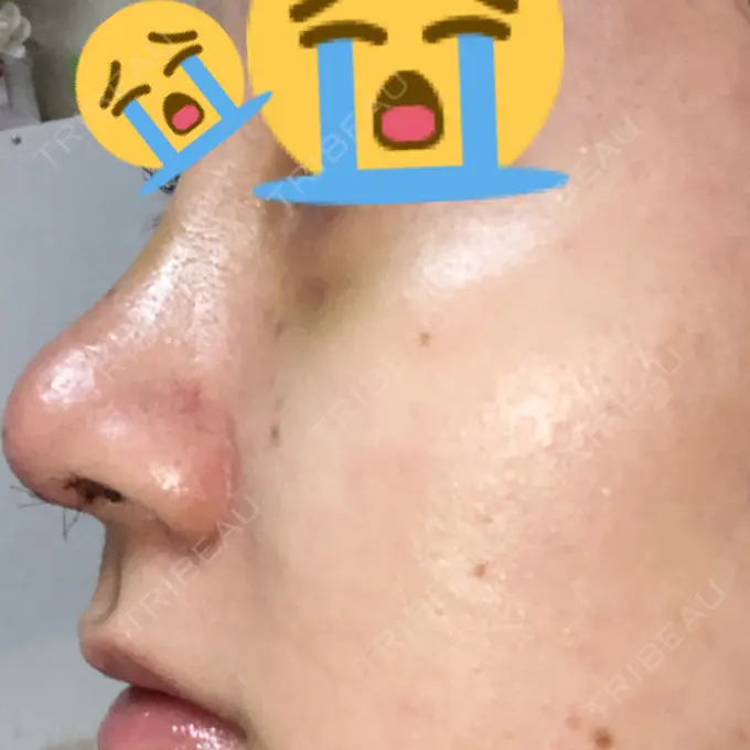 鼻尖形成（切開） / 鼻中隔延長（切開） / 眉間プロテーゼ 湘南美容クリニック 名古屋栄院 DAY 3 メイン用