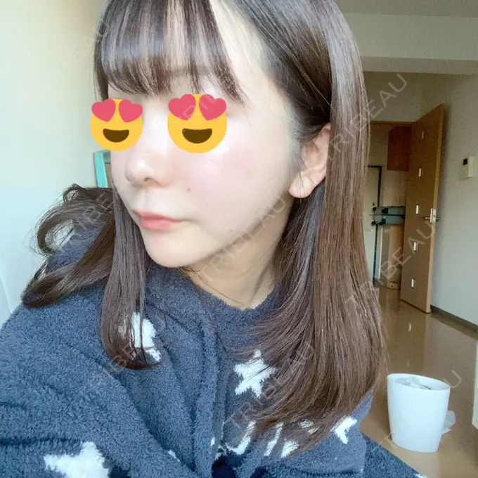 タレ目形成・グラマラスライン（切開） / 切開リフト ドクターゴールドマンクリニック 東京高輪院 AFTER メイン用