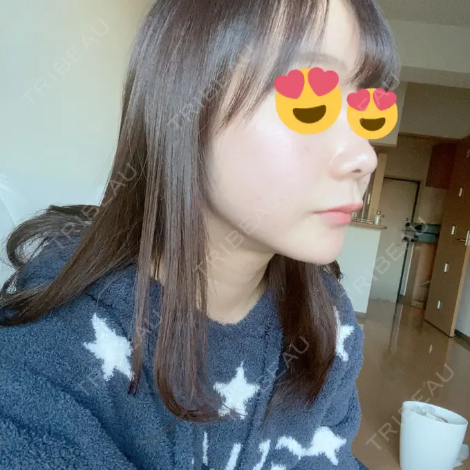 タレ目形成・グラマラスライン（切開） / 切開リフト ドクターゴールドマンクリニック 東京高輪院 DAY 92 メイン用