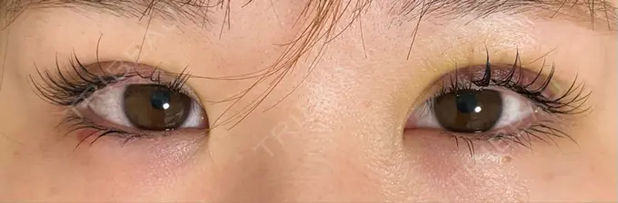 二重埋没 / ヒアルロン酸注入（涙袋） / ヒアルロン酸注入（目の下） 湘南美容クリニック 千葉センシティ院 DAY 5 メイン用