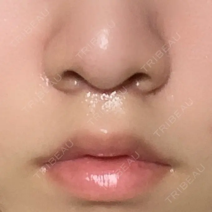 人中短縮 新宿ラクル美容外科クリニック 新宿院 DAY 29 メイン用