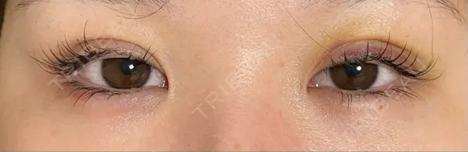 二重埋没 / ヒアルロン酸注入（涙袋） / ヒアルロン酸注入（目の下） 湘南美容クリニック 千葉センシティ院 DAY 6 メイン用