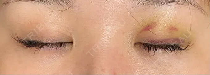 二重埋没 / ヒアルロン酸注入（涙袋） / ヒアルロン酸注入（目の下） 湘南美容クリニック 千葉センシティ院 DAY 6 メイン用