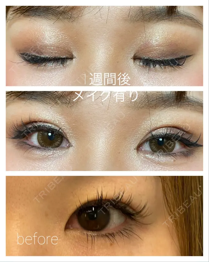 二重埋没 / ヒアルロン酸注入（涙袋） / ヒアルロン酸注入（目の下） 湘南美容クリニック 千葉センシティ院 DAY 7 メイン用