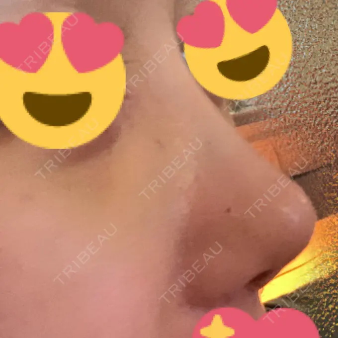 鼻尖形成（切開） / 小鼻縮小（切開） / 軟骨移植 / ワシ鼻修正・ハンプ切除 / 鼻尖縮小 / その他（鼻） B-LINE CLINIC 池袋院 DAY 86 メイン用