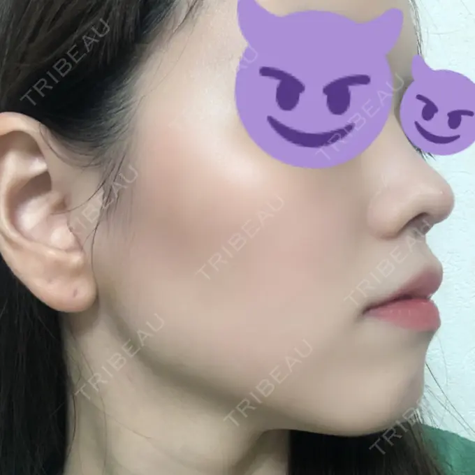 鼻尖形成（切開） みずほクリニック DAY 18 メイン用