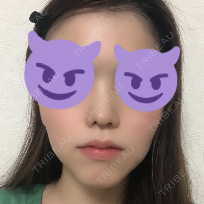 鼻尖形成（切開） みずほクリニック DAY 18 メイン用