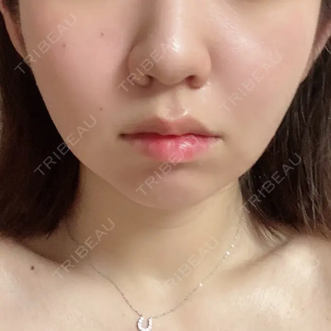 糸リフト / 肌ヒアルロン酸注入（たるみ・シワ改善） / ボトックス（エラ・小顔） TCB東京中央美容外科 新宿東口院 AFTER メイン用