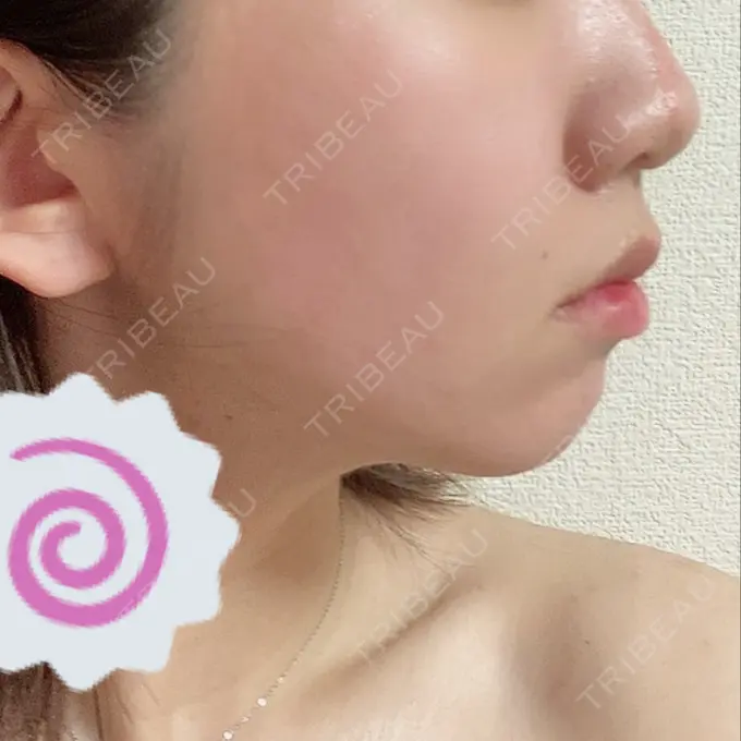 糸リフト / 肌ヒアルロン酸注入（たるみ・シワ改善） / ボトックス（エラ・小顔） TCB東京中央美容外科 新宿東口院 DAY 39 メイン用