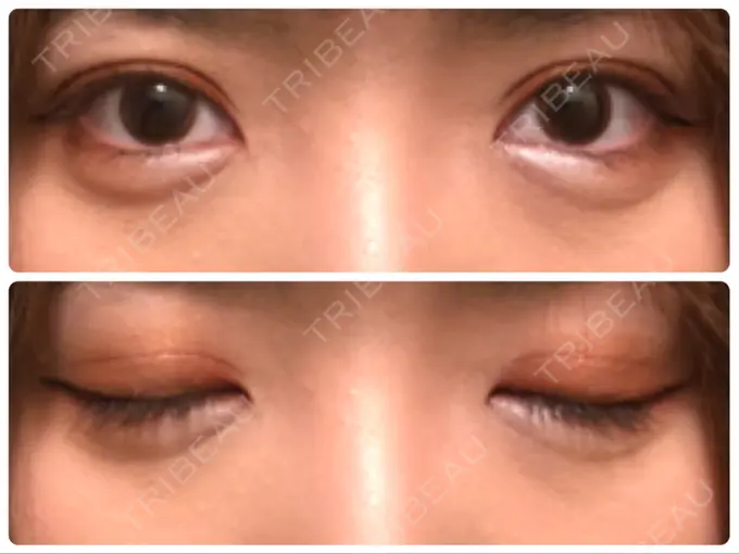 眼瞼下垂（切開） Taide Suenaga Clinic（タイデスエナガクリニック） DAY 90 メイン用