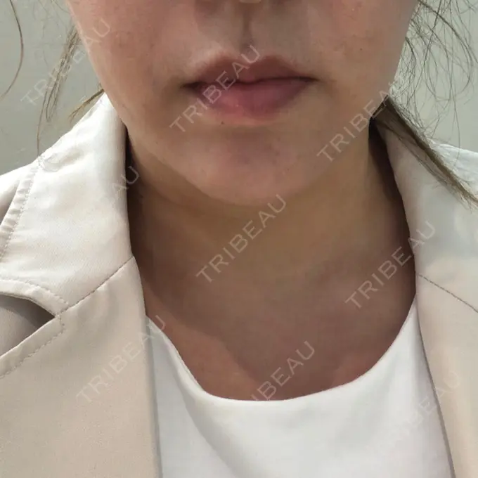 脂肪溶解注射（顔） 赤坂プレミアクリニック DAY 0 メイン用