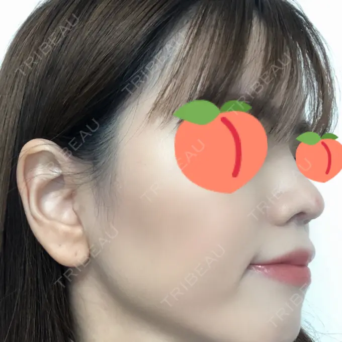 鼻尖形成（切開） みずほクリニック DAY 22 メイン用