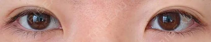 二重埋没 青山セレスクリニック 青山院 AFTER メイン用