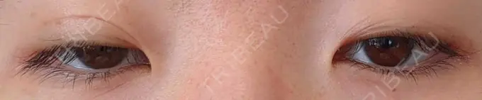 二重埋没 青山セレスクリニック 青山院 DAY 16 メイン用