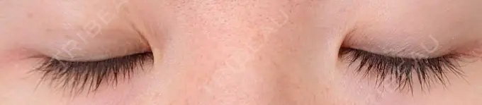 二重埋没 青山セレスクリニック 青山院 DAY 16 メイン用