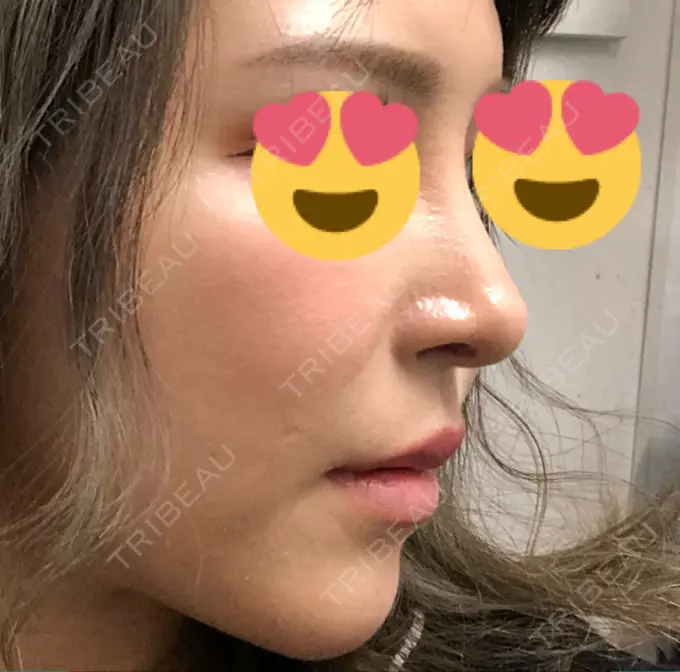 隆鼻術 / 鼻中隔延長（切開） / 軟骨移植 / 骨切幅寄せ / プロテーゼ除去 / 鼻修正 / 真皮移植 / 鼻孔縁下降 KOKO整形外科 AFTER メイン用