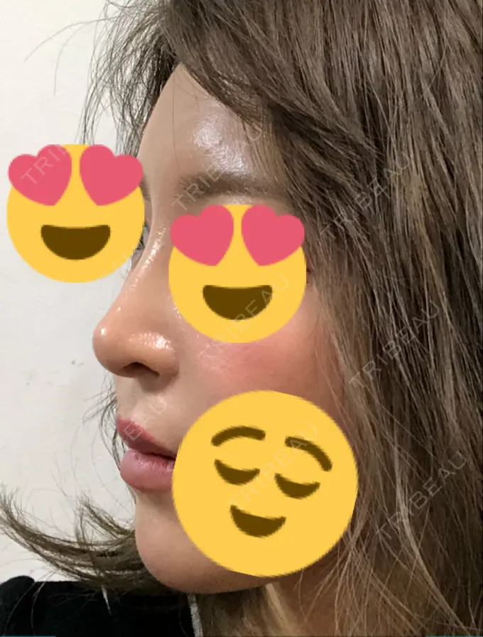 隆鼻術 / 鼻中隔延長（切開） / 軟骨移植 / 骨切幅寄せ / プロテーゼ除去 / 鼻修正 / 真皮移植 / 鼻孔縁下降 KOKO整形外科 DAY 340 メイン用