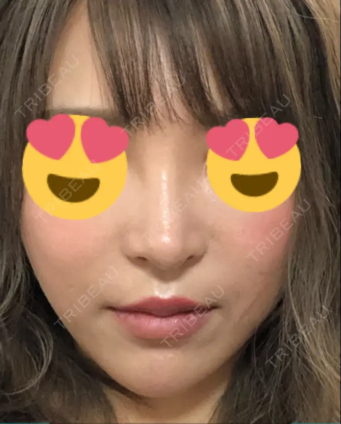 隆鼻術 / 鼻中隔延長（切開） / 軟骨移植 / 骨切幅寄せ / プロテーゼ除去 / 鼻修正 / 真皮移植 / 鼻孔縁下降 KOKO整形外科 DAY 340 メイン用