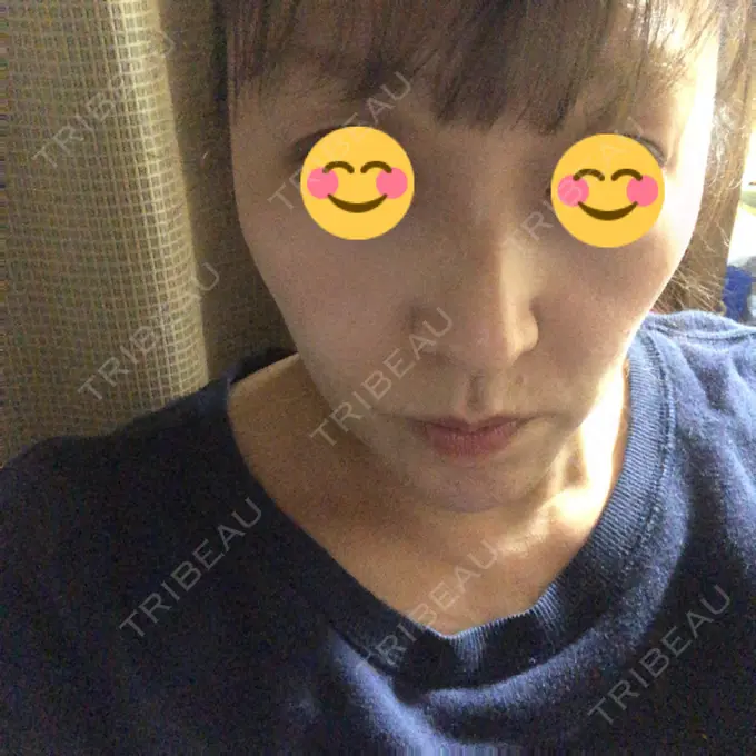 脂肪溶解注射（顔） 赤坂プレミアクリニック DAY 3 メイン用