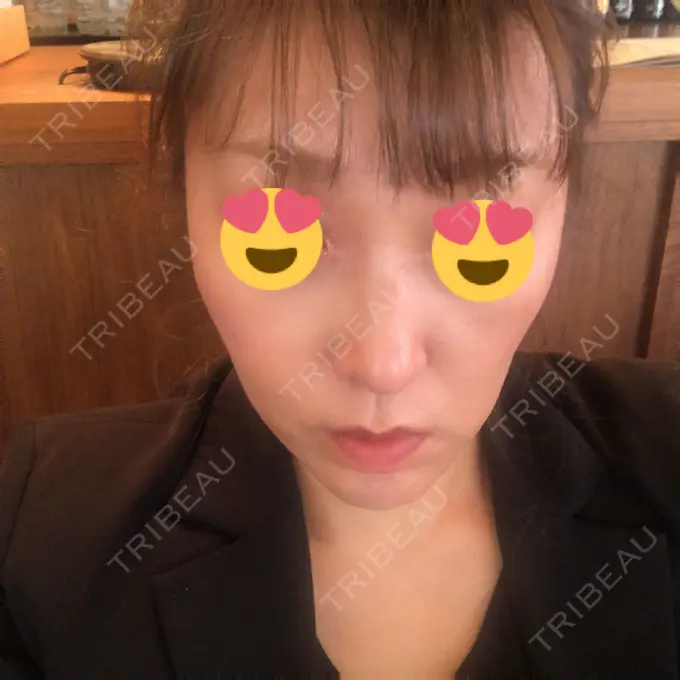 脂肪溶解注射（顔） 赤坂プレミアクリニック DAY 6 メイン用