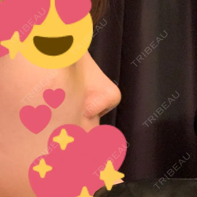 鼻尖形成（切開） / 小鼻縮小（切開） / 軟骨移植 / ワシ鼻修正・ハンプ切除 / 鼻尖縮小 / その他（鼻） B-LINE CLINIC 池袋院 DAY 94 メイン用