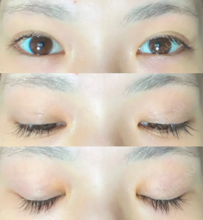 二重切開 有楽町高野美容クリニック DAY 191 メイン用