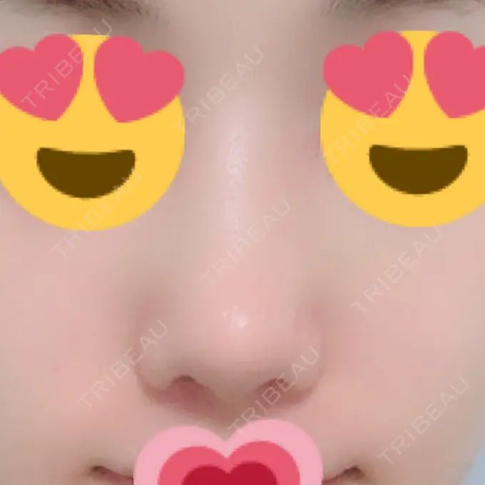 鼻尖形成（切開） / 小鼻縮小（切開） / 軟骨移植 / ワシ鼻修正・ハンプ切除 / 鼻尖縮小 / その他（鼻） B-LINE CLINIC 池袋院 DAY 116 メイン用