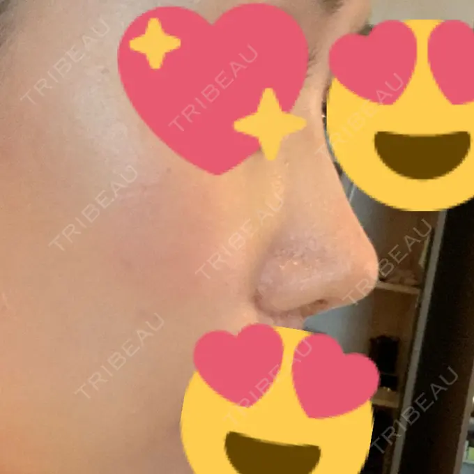 鼻尖形成（切開） / 小鼻縮小（切開） / 軟骨移植 / ワシ鼻修正・ハンプ切除 / 鼻尖縮小 / その他（鼻） B-LINE CLINIC 池袋院 DAY 116 メイン用