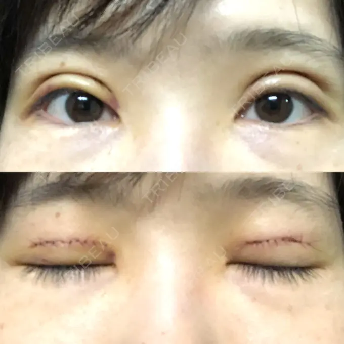 二重切開 ゆめビューティークリニック DAY 4 メイン用