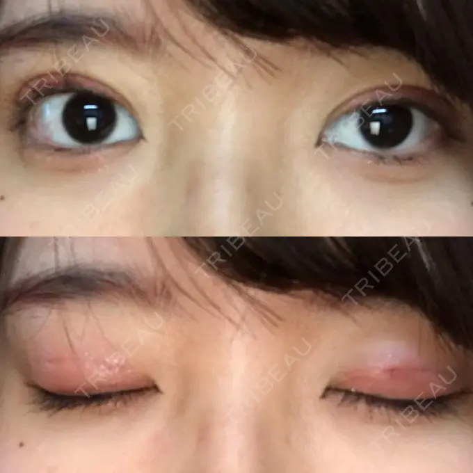 二重埋没 新宿美容外科クリニック 立川院 DAY 1 メイン用