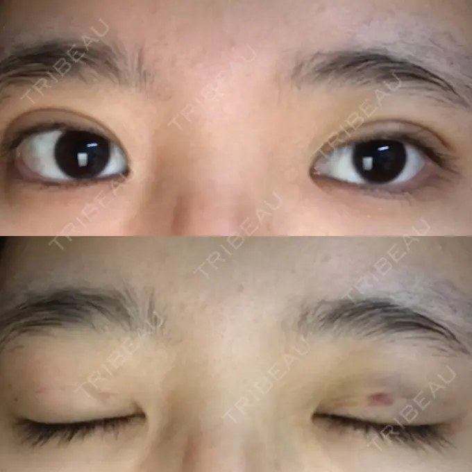 二重埋没 新宿美容外科クリニック 立川院 DAY 3 メイン用