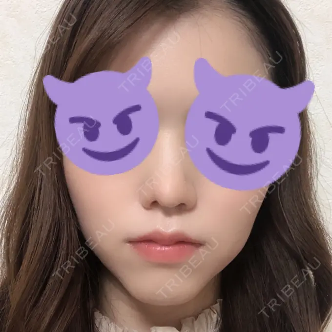 鼻尖形成（切開） みずほクリニック DAY 30 メイン用